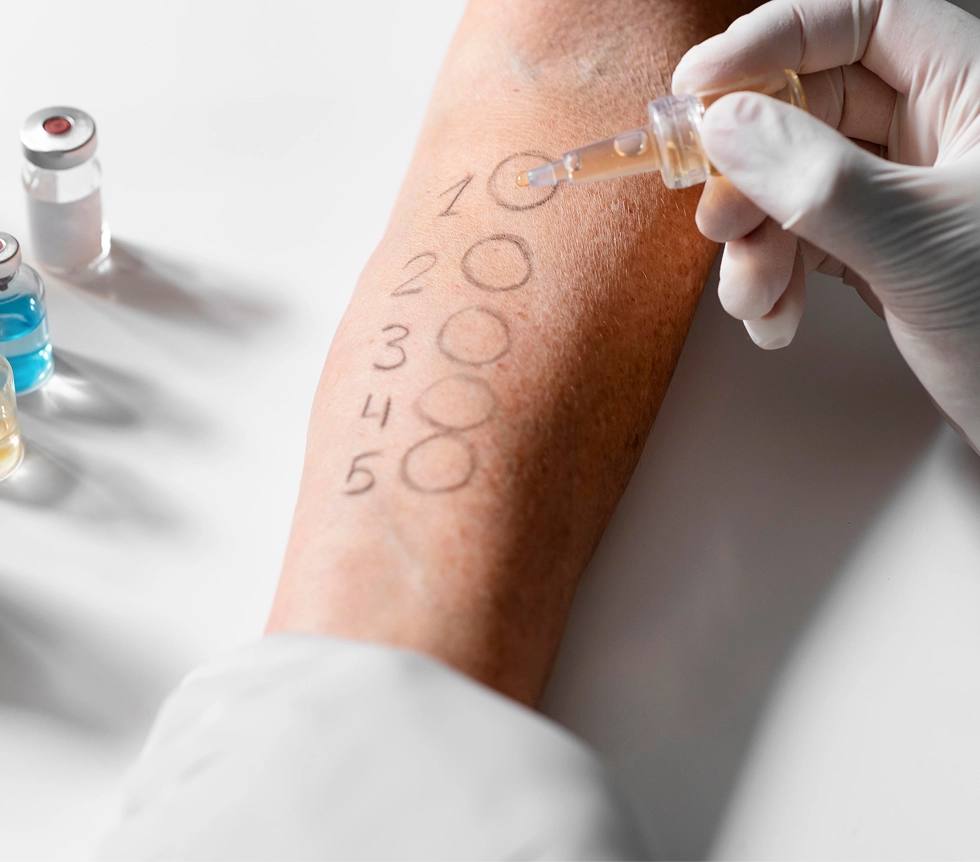 Allergietest am Unterarm